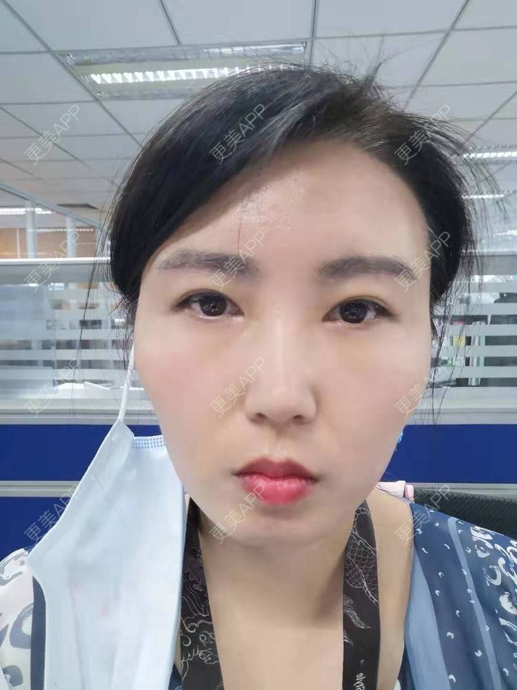 更美 - blinglee的切眉经验 | 切眉 | 深圳
