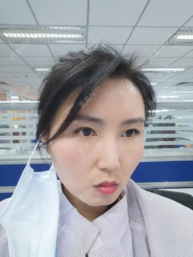 更美 - blinglee的切眉经验 | 切眉 | 深圳