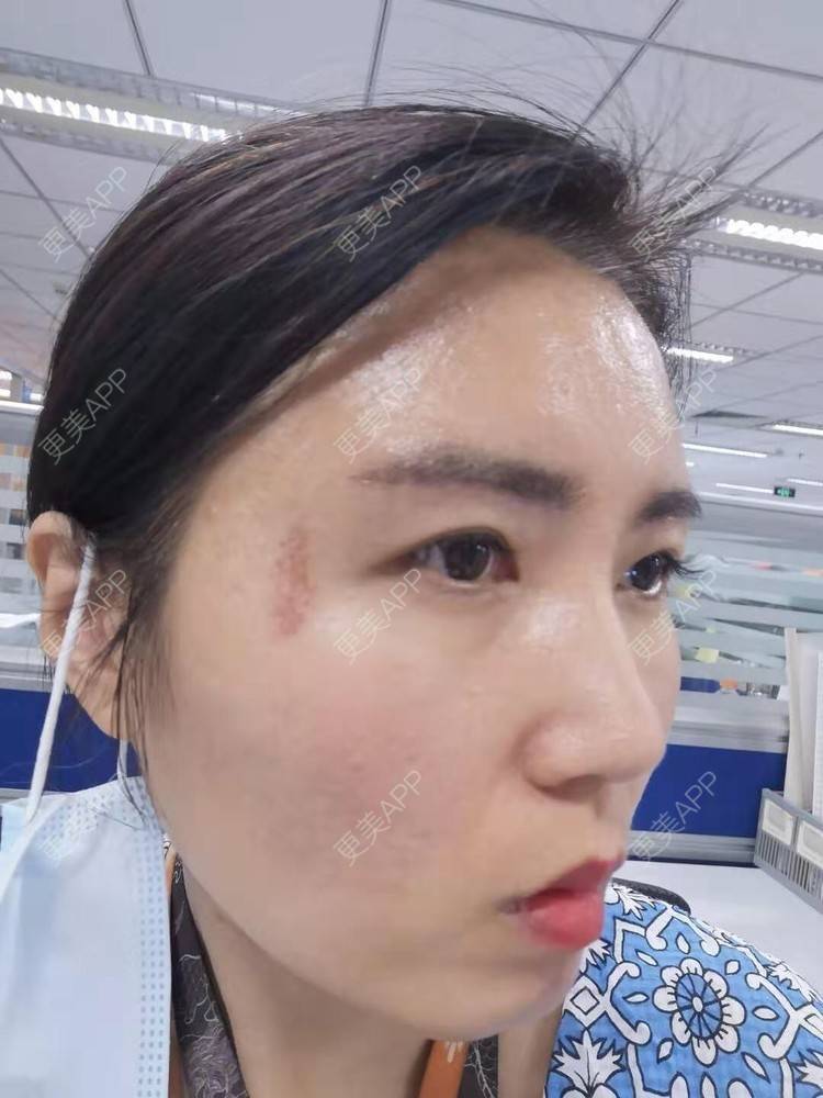 更美 - blinglee的切眉经验 | 切眉 | 深圳