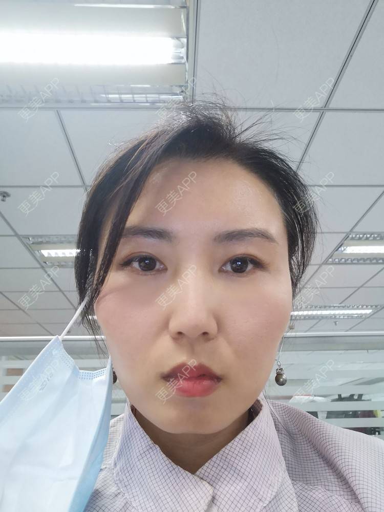 更美 - blinglee的切眉经验 | 切眉 | 深圳
