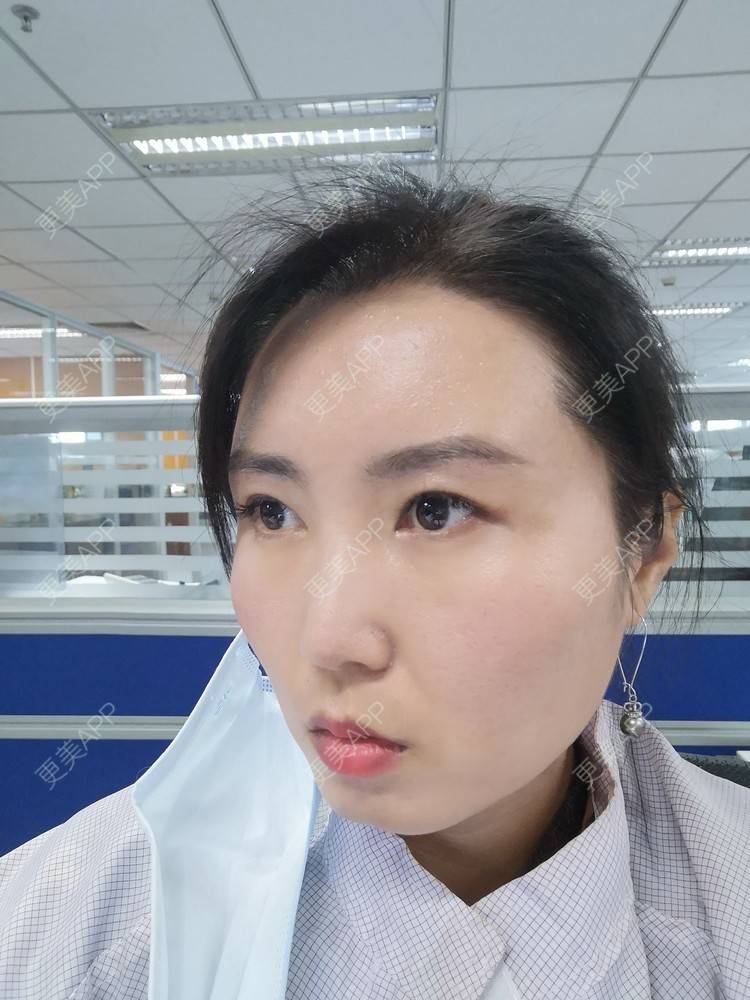 更美 - blinglee的切眉经验 | 切眉 | 深圳