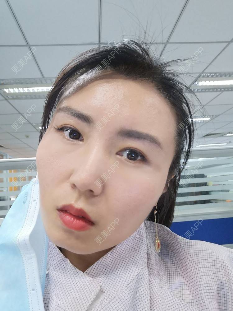 更美 - blinglee的切眉经验 | 切眉 | 深圳
