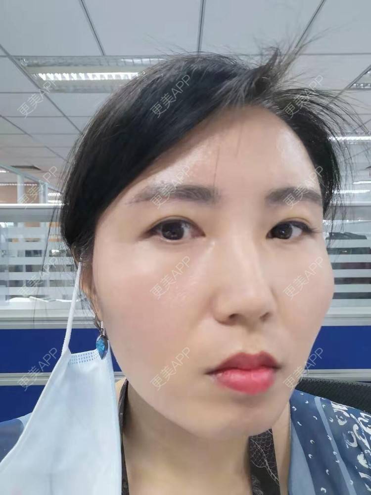 更美 - blinglee的切眉经验 | 切眉 | 深圳