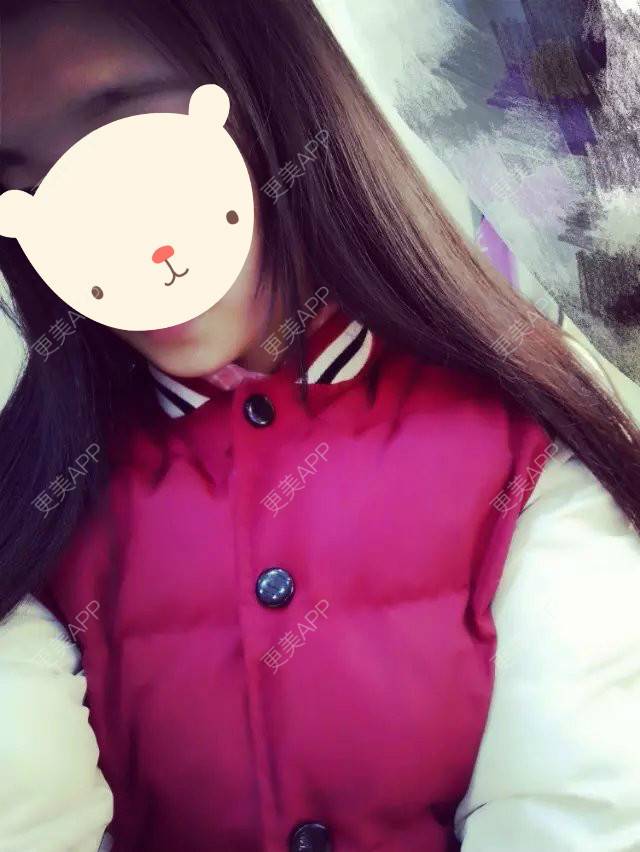 更美 - 醉了就可以表白了窖的阴唇整形经验 | 上海 | 阴唇整形