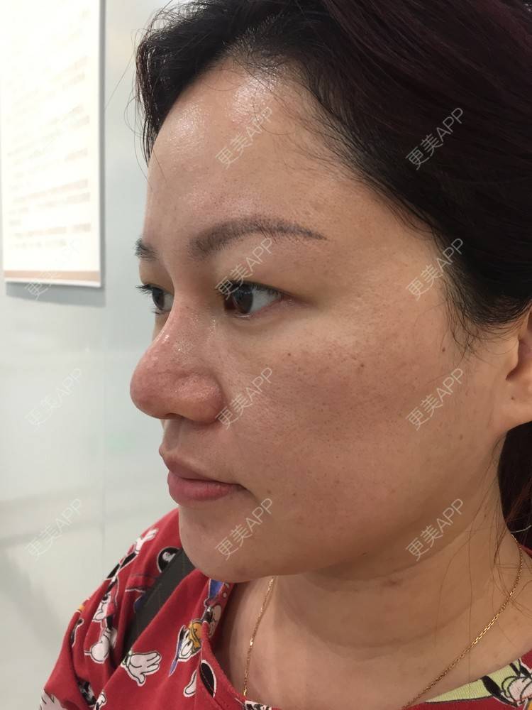 更美 - 克里克里的切眉经验 | 切眉 | 深圳
