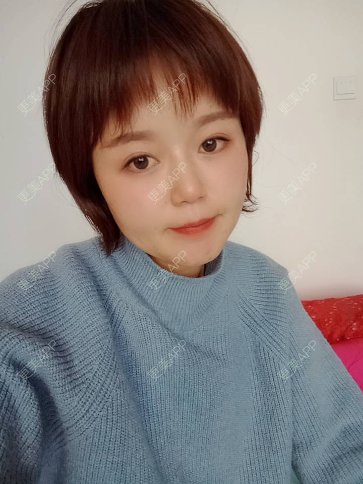 更美 - 乘风破浪小美眉的开外眼角经验 | 开外眼角 | 重庆 | 提眉修复