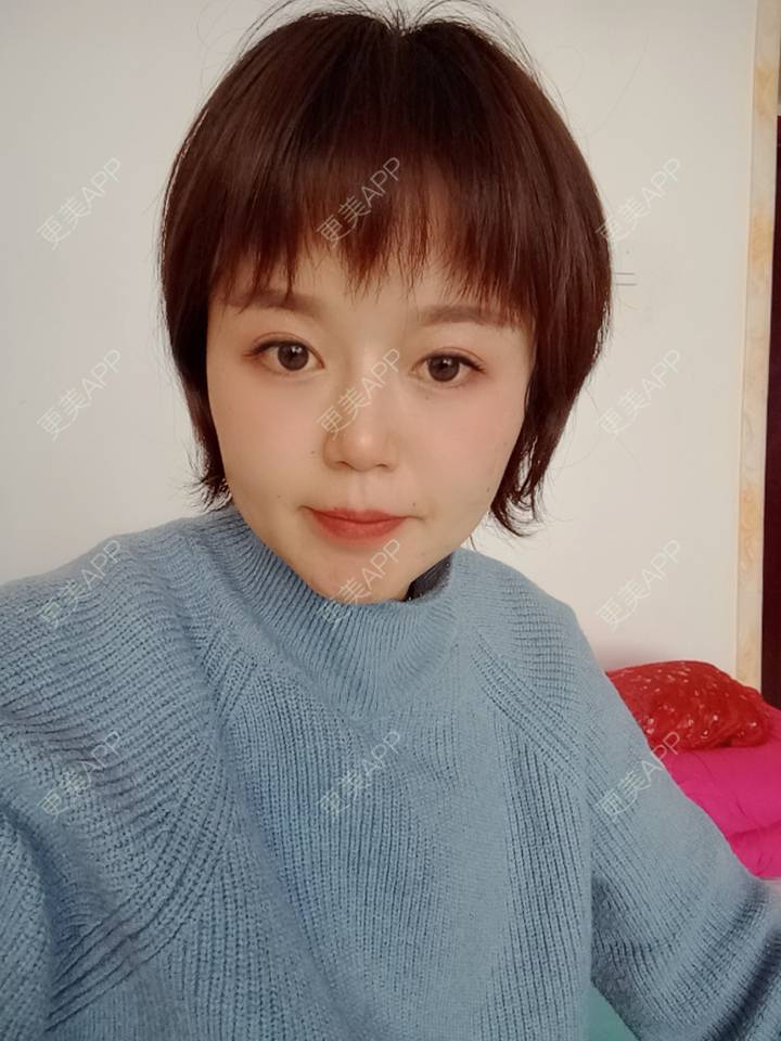 更美 - 乘风破浪小美眉的开外眼角经验 | 开外眼角 | 重庆 | 提眉修复