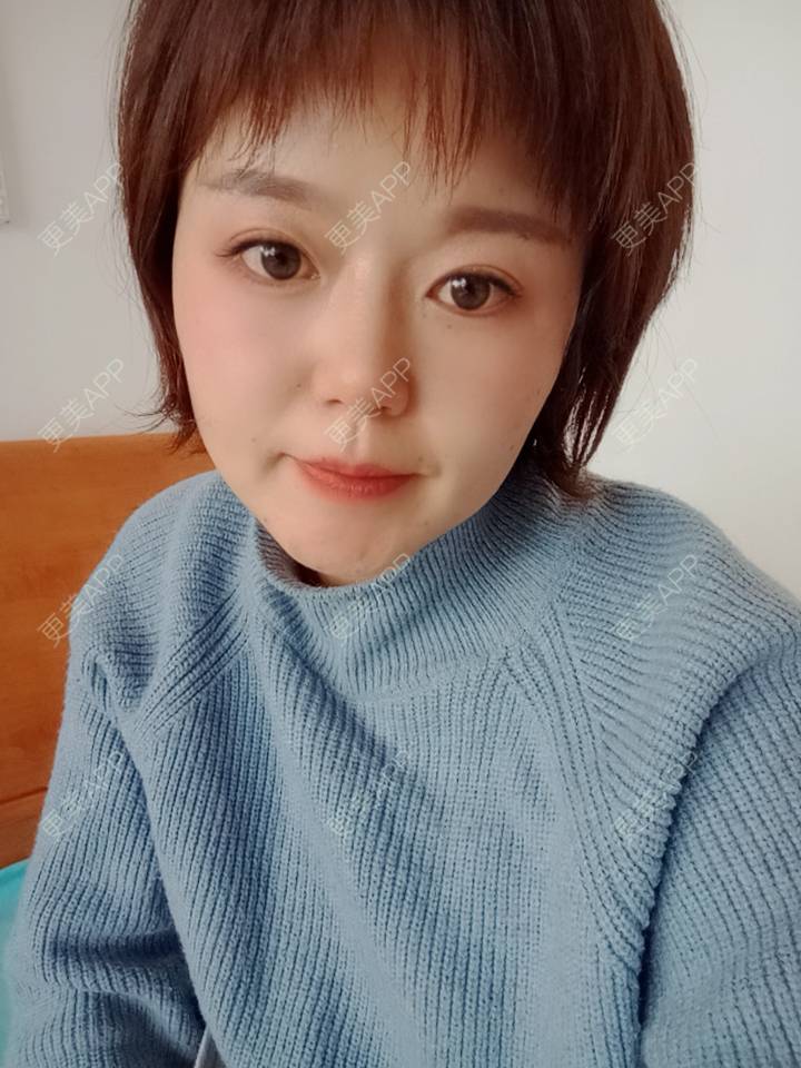 更美 - 乘风破浪小美眉的开外眼角经验 | 开外眼角 | 重庆 | 提眉修复