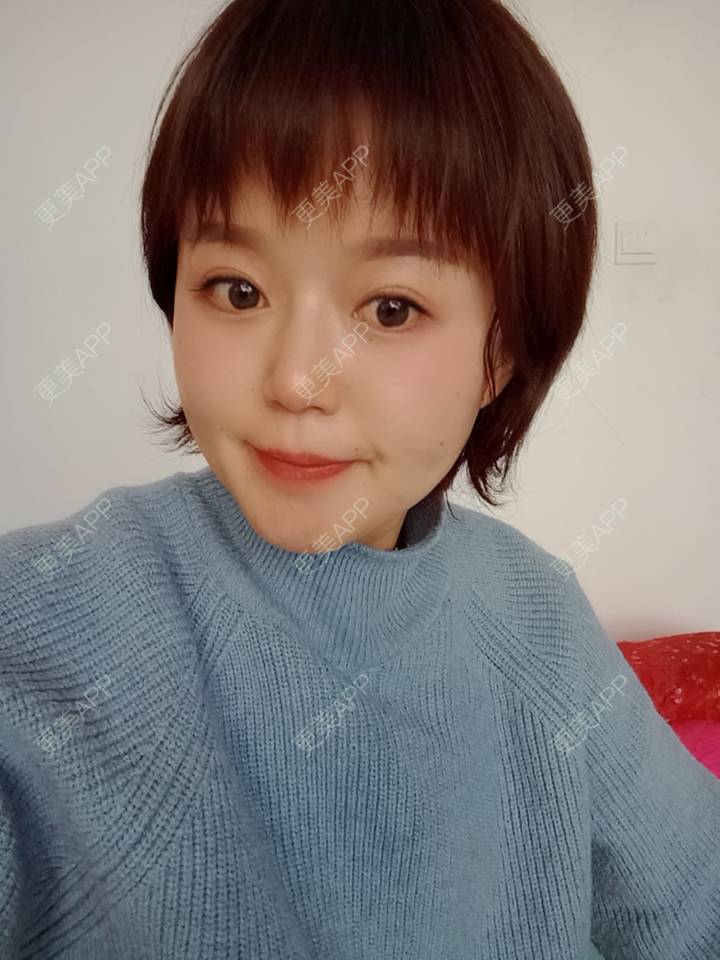 更美 - 乘风破浪小美眉的开外眼角经验 | 开外眼角 | 重庆 | 提眉修复