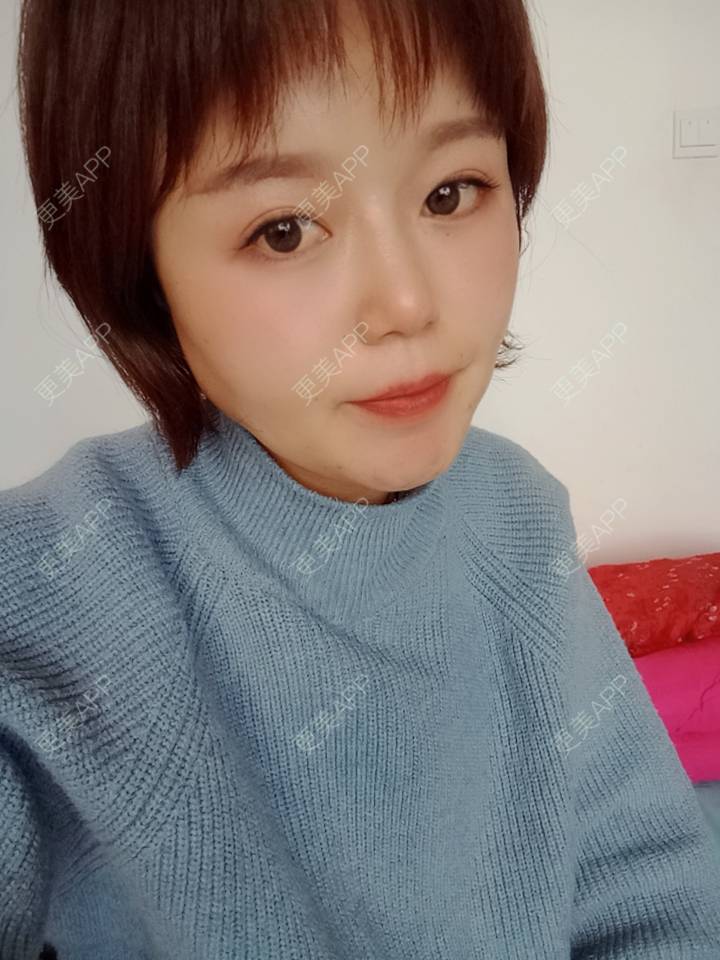 更美 - 乘风破浪小美眉的开外眼角经验 | 开外眼角 | 重庆 | 提眉修复