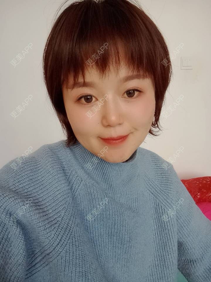 更美 - 乘风破浪小美眉的开外眼角经验 | 开外眼角 | 重庆 | 提眉修复