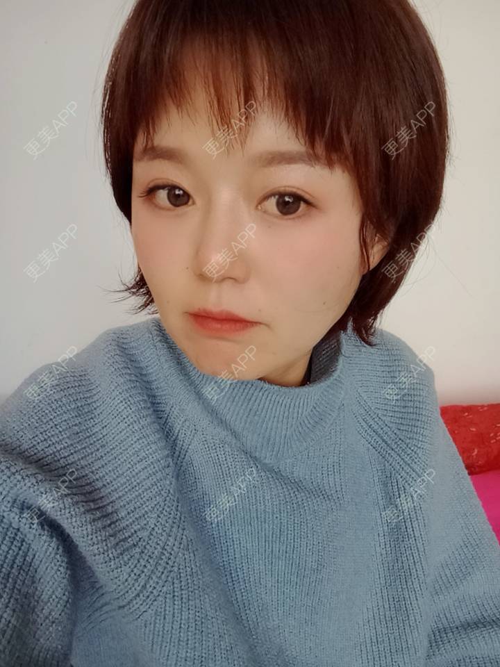 更美 - 乘风破浪小美眉的开外眼角经验 | 开外眼角 | 重庆 | 提眉修复