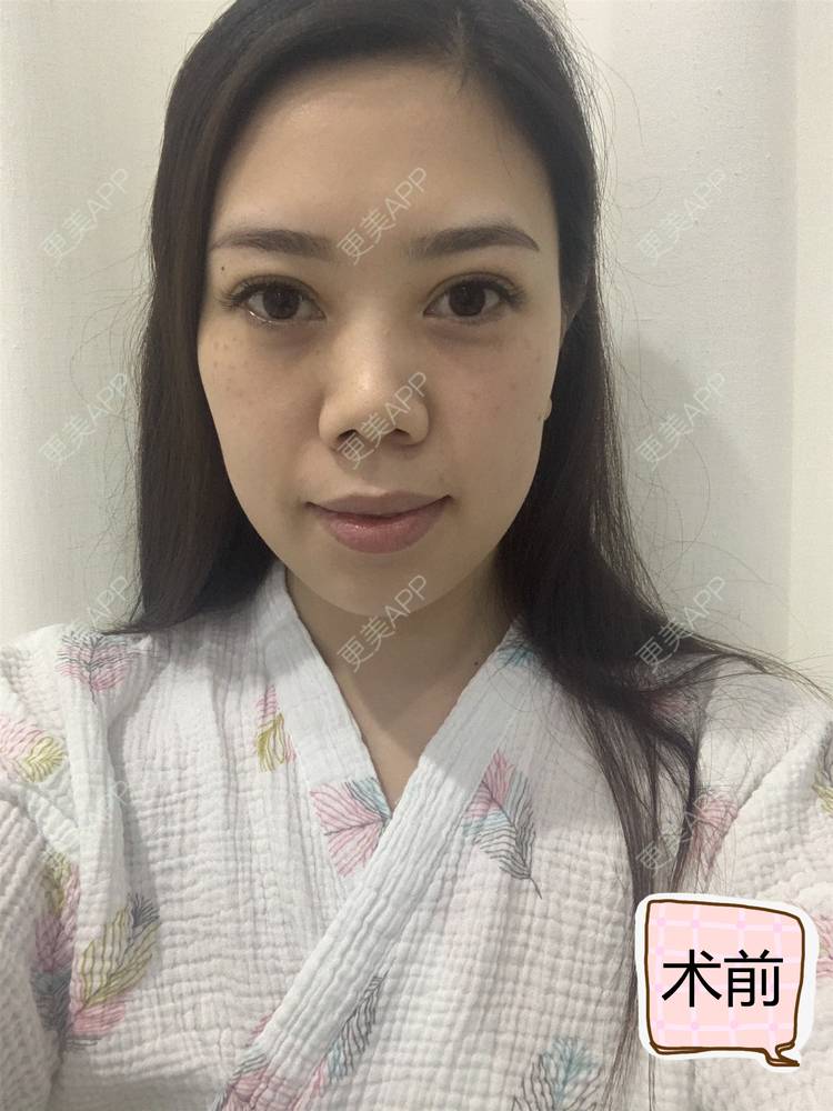 更美 - 小鹿酥的鼻部多项经验 | 鼻部多项 | 鼻翼缩小 | 重庆 | 假体垫鼻基底 | 鼻小柱延长 | 宽鼻矫正