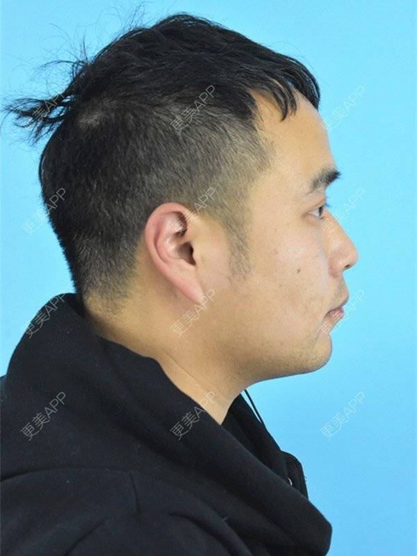 更美 - 更美用户8ZtJfJloBn的双下巴吸脂经验 | 双下巴吸脂 | 昆明