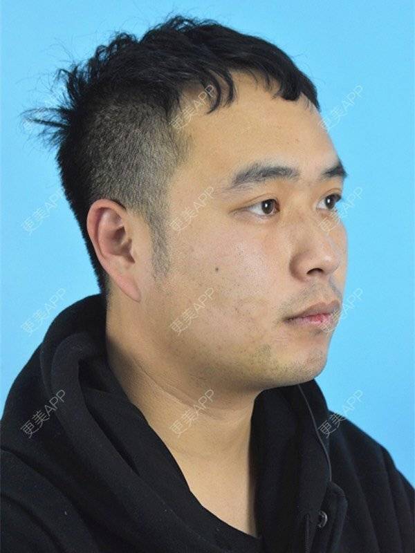 更美 - 更美用户8ZtJfJloBn的双下巴吸脂经验 | 双下巴吸脂 | 昆明