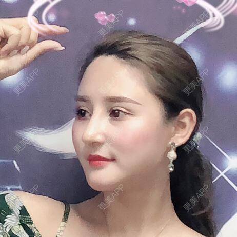 更美 - 更美用户JaSMyrpxXf的自体脂肪丰额头经验 | 自体脂肪丰额头