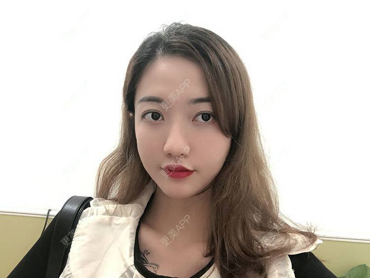 更美 - 更美用户bI9NkJJS6q的嗨体淡化黑眼圈经验 | 嗨体淡化黑眼圈 | 嗨体淡化黑眼圈 | 广州