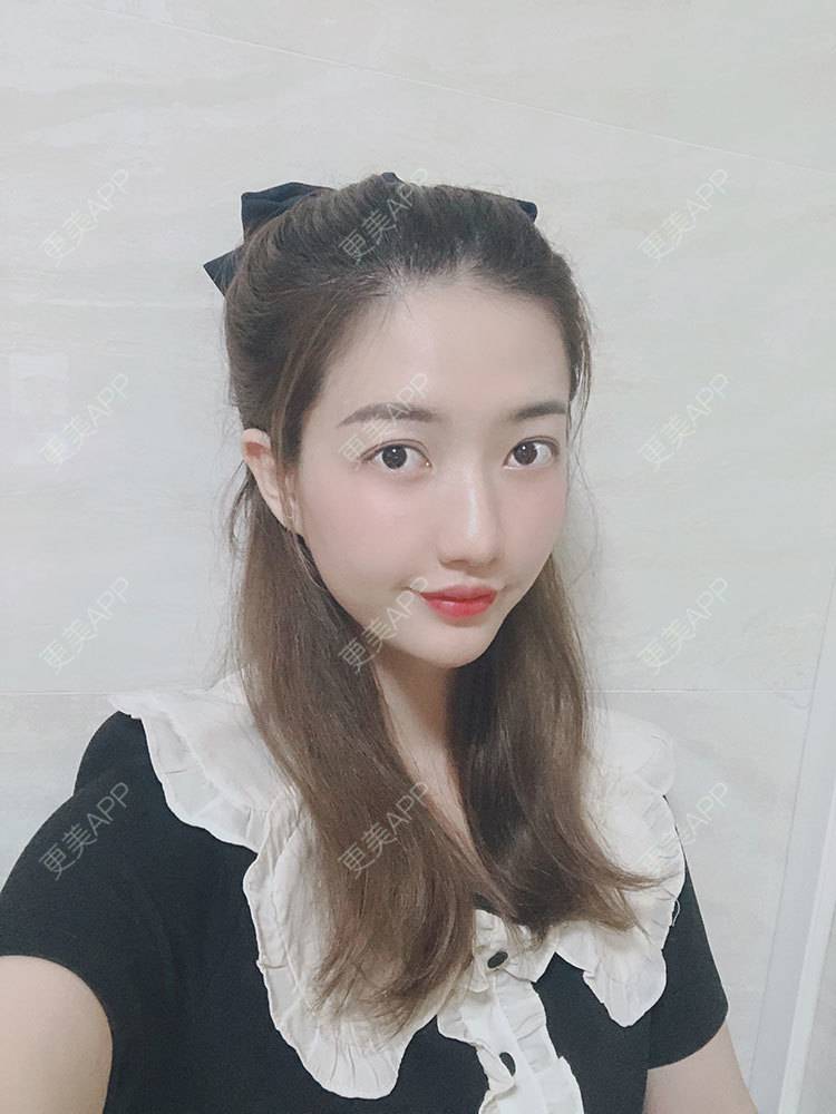 更美 - 更美用户bI9NkJJS6q的嗨体淡化黑眼圈经验 | 嗨体淡化黑眼圈 | 嗨体淡化黑眼圈 | 广州