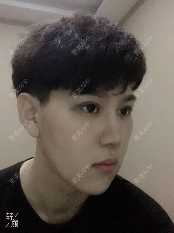 更美 - 更美用户UDRNkzaJUI的光纤瘦脸经验 | 光纤瘦脸