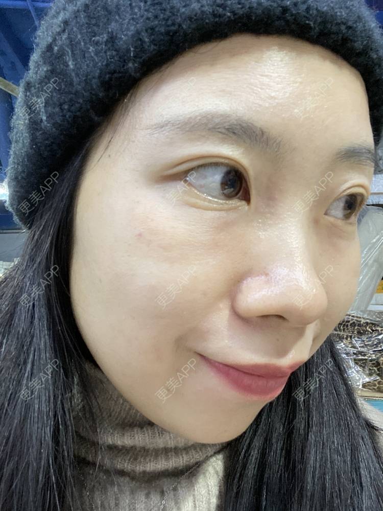 更美 - 更美用户IwEnKzK4nU的黄金微针经验 | 黄金微针 | 广州