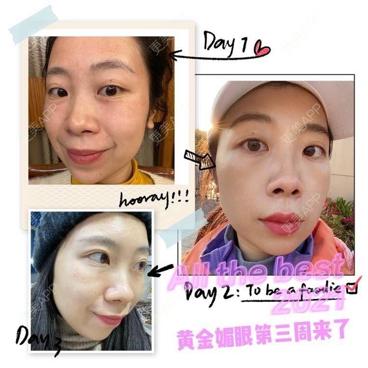 更美 - 更美用户IwEnKzK4nU的黄金微针经验 | 黄金微针 | 广州
