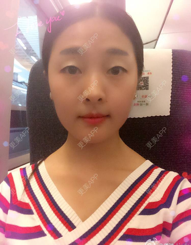 更美 - 更美用户DVJNfKigag的光子嫩肤经验 | 光子嫩肤