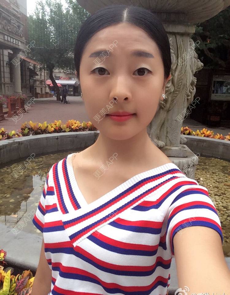 更美 - 更美用户DVJNfKigag的光子嫩肤经验 | 光子嫩肤
