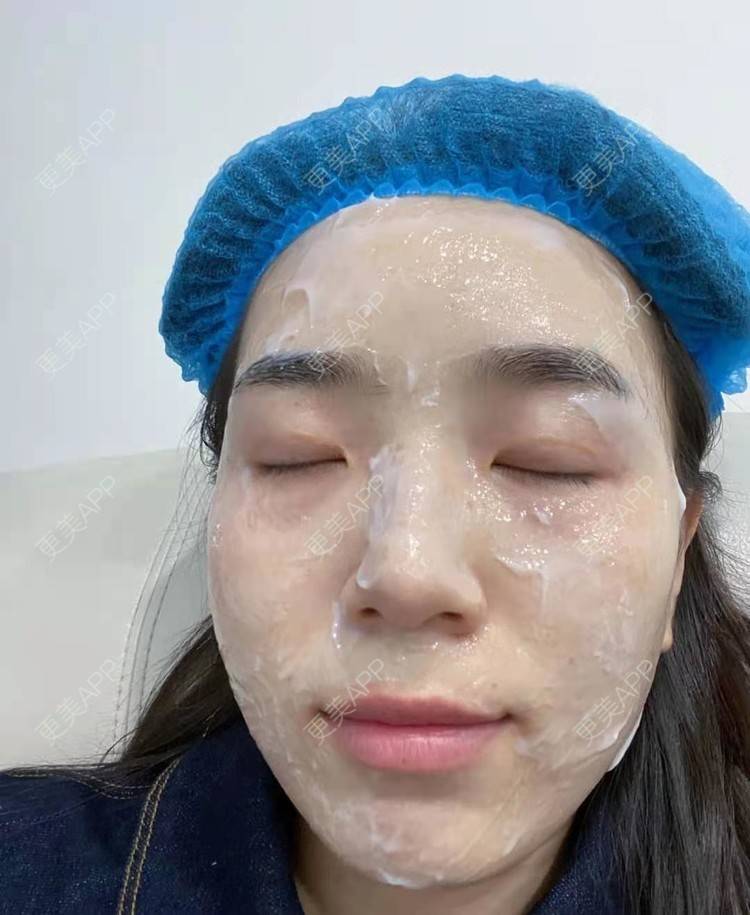 更美 - 更美用户pWocUiNkGM的激光淡斑经验 | 激光淡斑 | 上海
