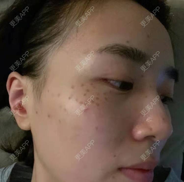 更美 - 更美用户pWocUiNkGM的激光淡斑经验 | 激光淡斑 | 上海