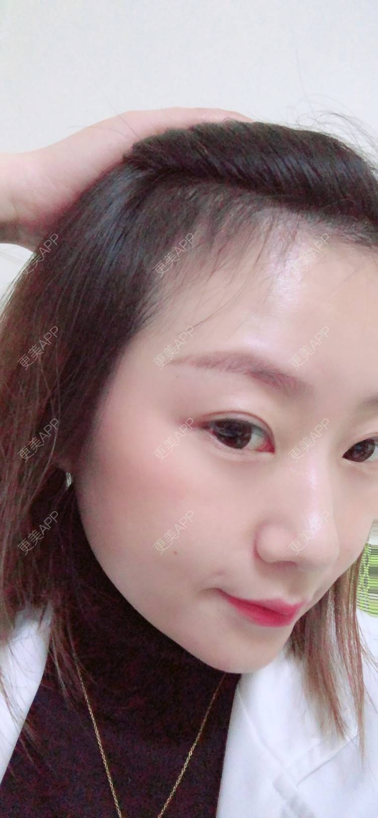 更美 - 更美用户4OHtRvkJJx的植发际线经验 | 视频日记 | 植发际线
