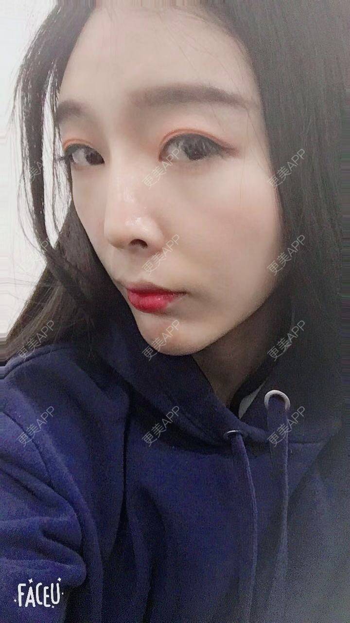 更美 - 更美用户F33d49fitv的自体脂肪垫下巴经验 | 北京 | 自体脂肪垫下巴