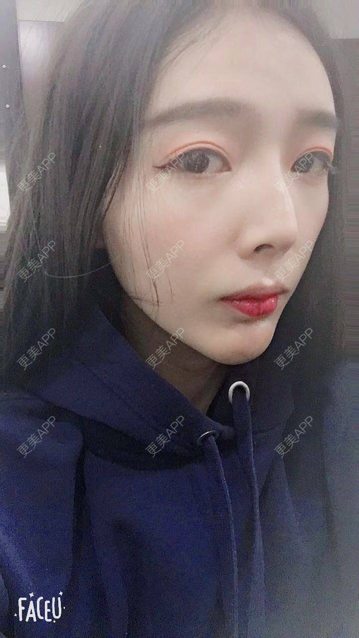 更美 - 更美用户F33d49fitv的自体脂肪垫下巴经验 | 北京 | 自体脂肪垫下巴