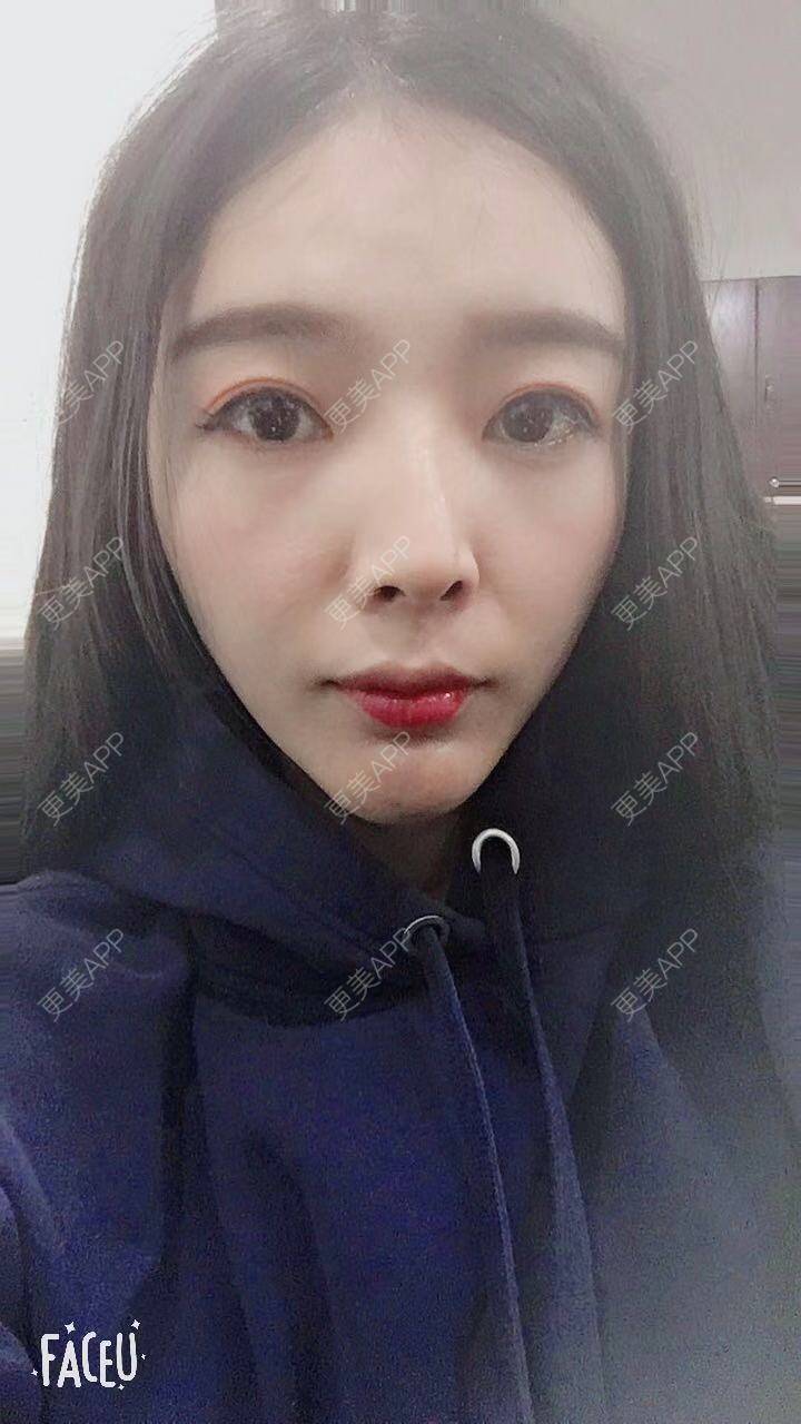 更美 - 更美用户F33d49fitv的自体脂肪垫下巴经验 | 北京 | 自体脂肪垫下巴