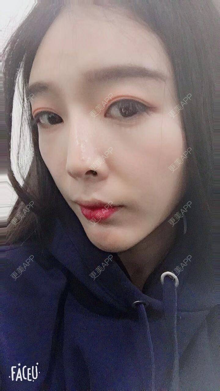 更美 - 更美用户F33d49fitv的自体脂肪垫下巴经验 | 北京 | 自体脂肪垫下巴