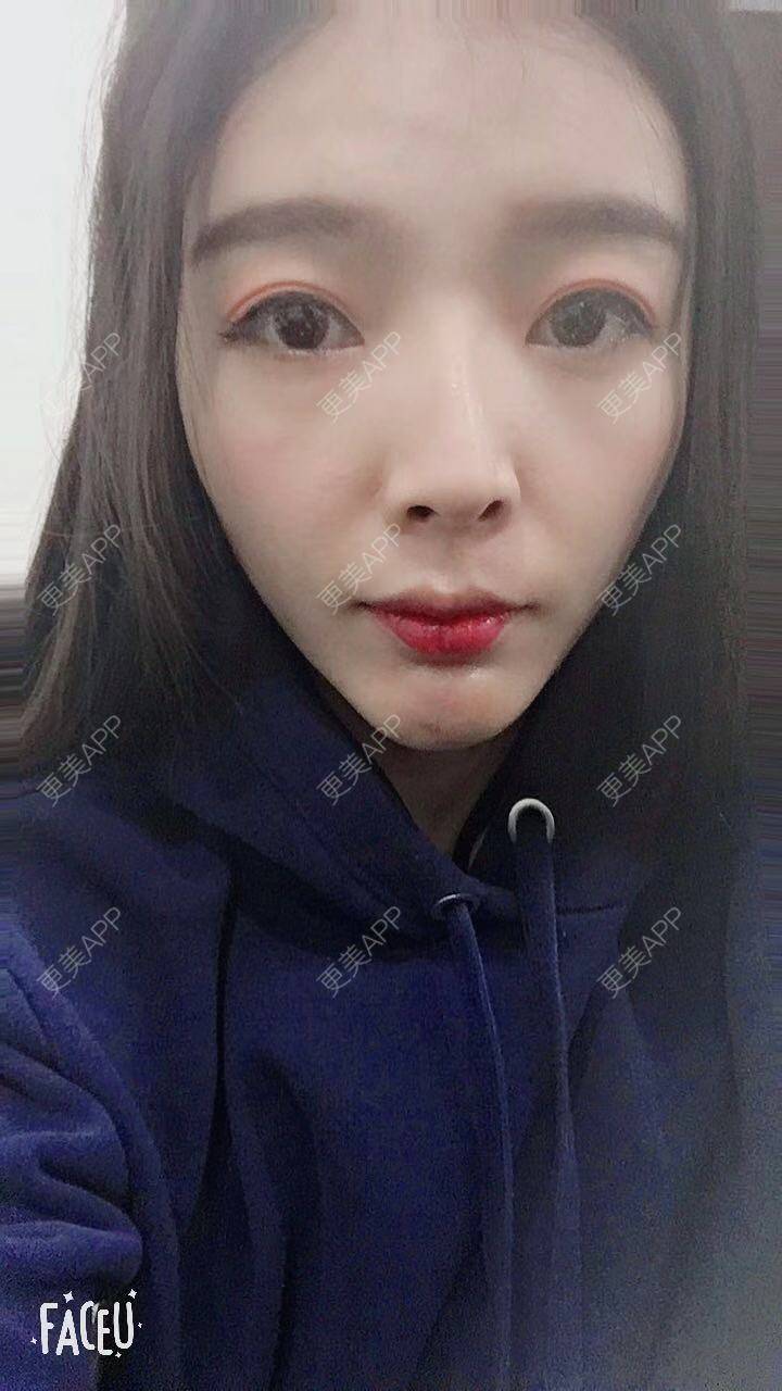 更美 - 更美用户F33d49fitv的自体脂肪垫下巴经验 | 北京 | 自体脂肪垫下巴