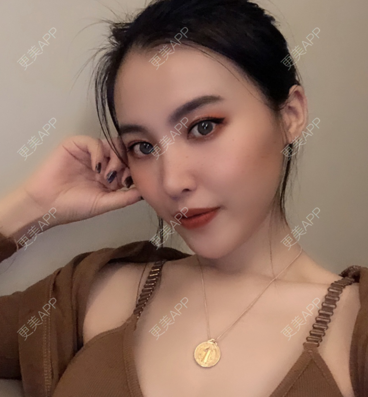 更美 - 更美用户6hXJA03iCs的玻尿酸法令纹经验 | 玻尿酸法令纹 | 视频日记