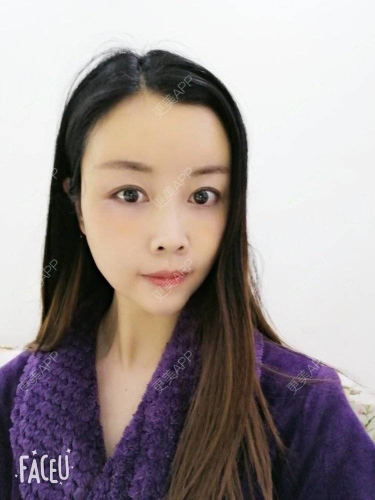 更美 - 更美用户BWcvDziBbe的自体脂肪丰面颊经验 | 南昌 | 自体脂肪丰面颊