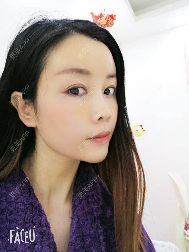 更美 - 更美用户BWcvDziBbe的自体脂肪丰面颊经验 | 南昌 | 自体脂肪丰面颊