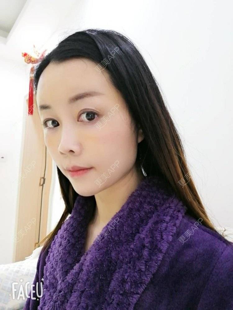 更美 - 更美用户BWcvDziBbe的自体脂肪丰面颊经验 | 南昌 | 自体脂肪丰面颊