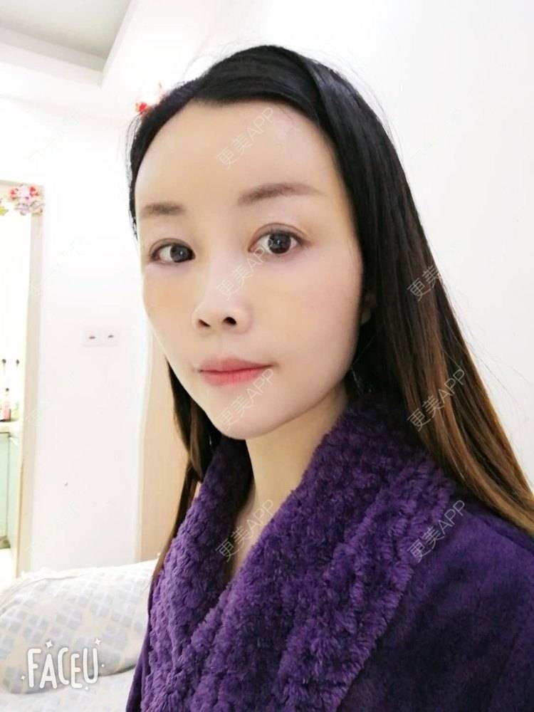 更美 - 更美用户BWcvDziBbe的自体脂肪丰面颊经验 | 南昌 | 自体脂肪丰面颊