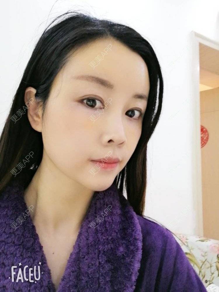 更美 - 更美用户BWcvDziBbe的自体脂肪丰面颊经验 | 南昌 | 自体脂肪丰面颊