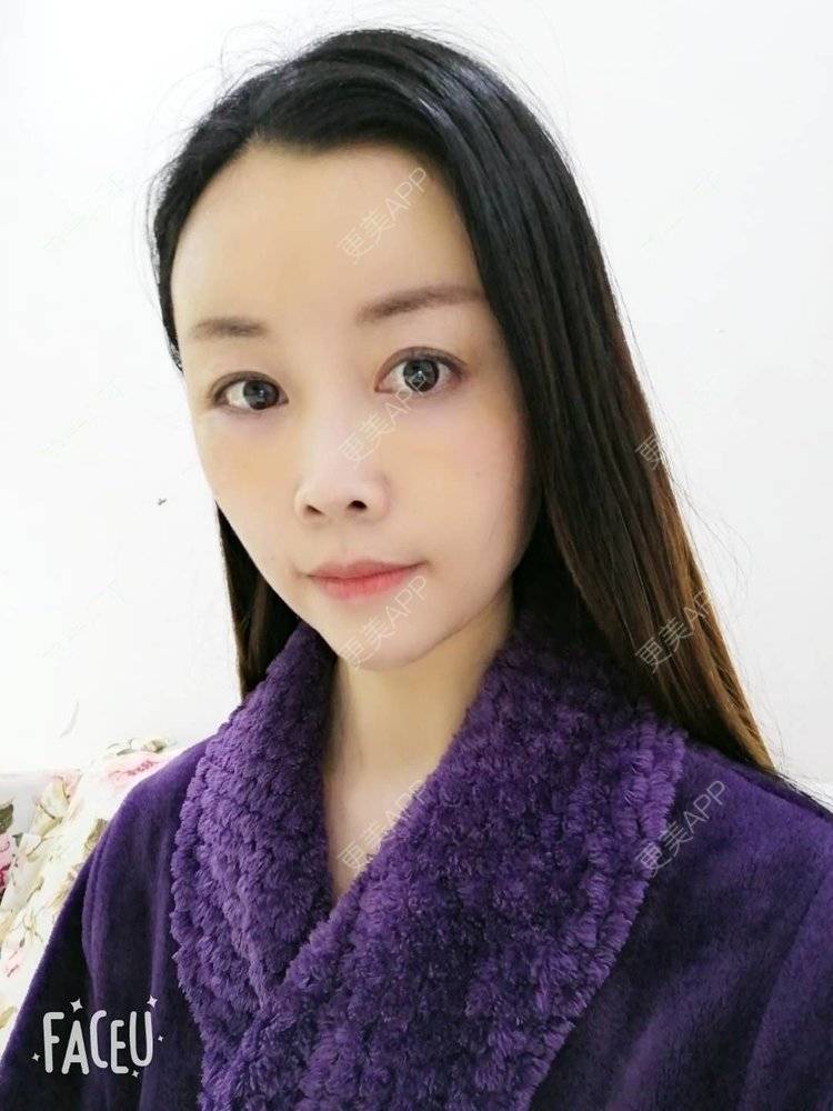 更美 - 更美用户BWcvDziBbe的自体脂肪丰面颊经验 | 南昌 | 自体脂肪丰面颊