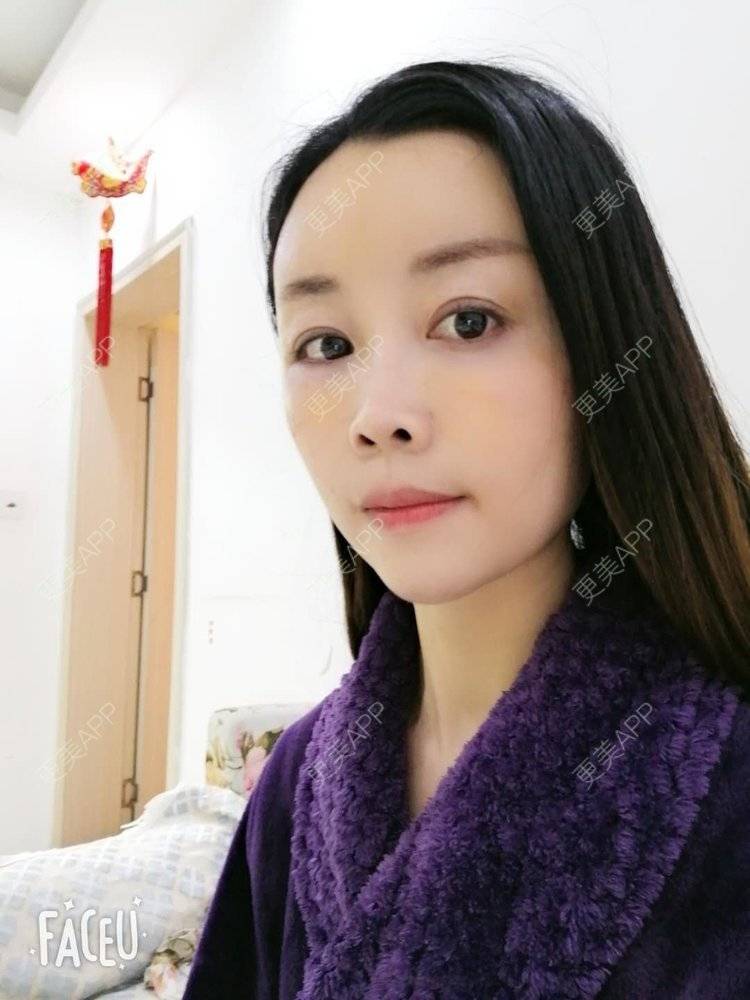 更美 - 更美用户BWcvDziBbe的自体脂肪丰面颊经验 | 南昌 | 自体脂肪丰面颊