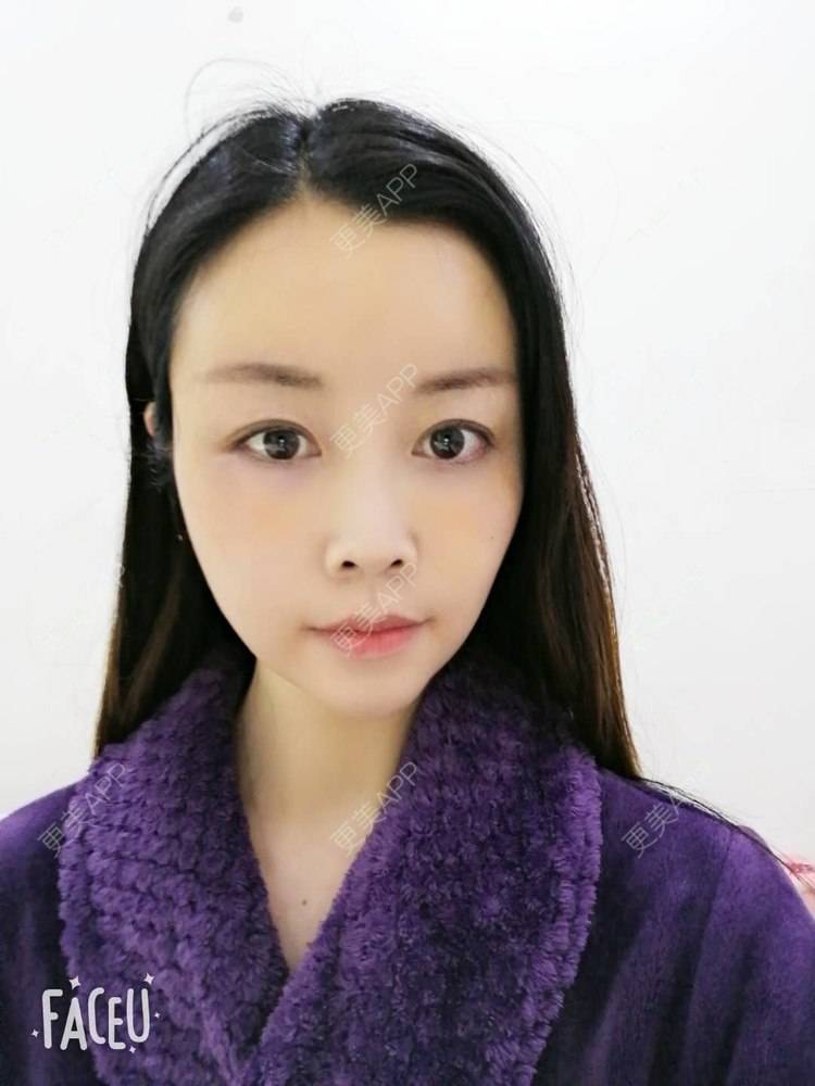 更美 - 更美用户BWcvDziBbe的自体脂肪丰面颊经验 | 南昌 | 自体脂肪丰面颊
