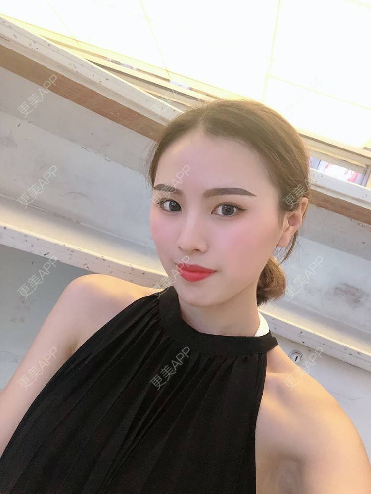 更美 - 更美用户TOjE4YH38k的隆鼻经验 | 北京 | 视频日记 | 隆鼻