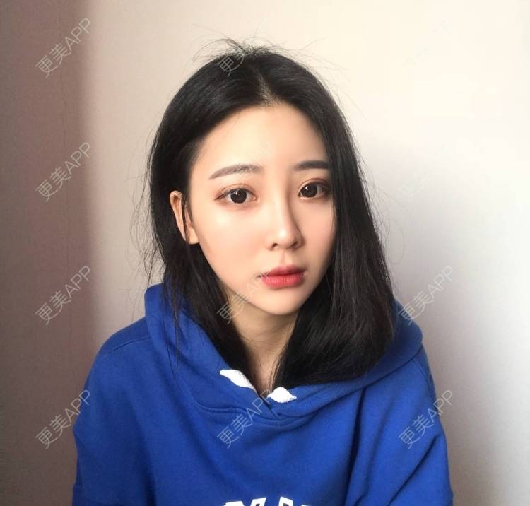 更美 - 迷乱花海拐的微针水光经验 | 德州 | 微针水光