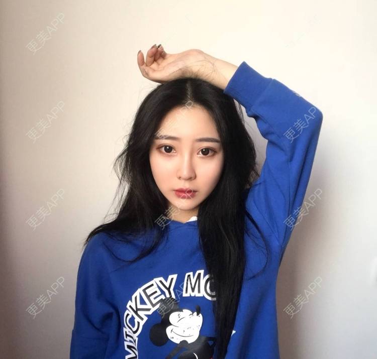 更美 - 迷乱花海拐的微针水光经验 | 德州 | 微针水光