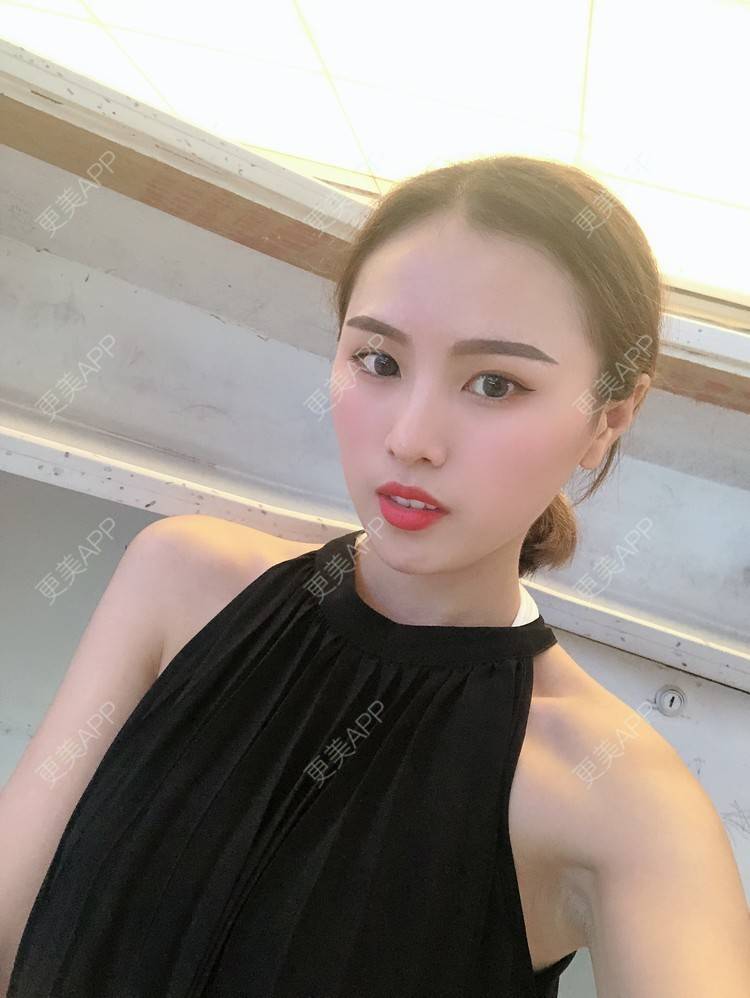 更美 - 更美用户TOjE4YH38k的隆鼻经验 | 北京 | 视频日记 | 隆鼻