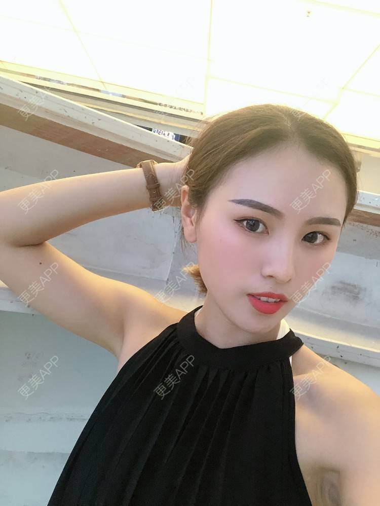 更美 - 更美用户TOjE4YH38k的隆鼻经验 | 北京 | 视频日记 | 隆鼻