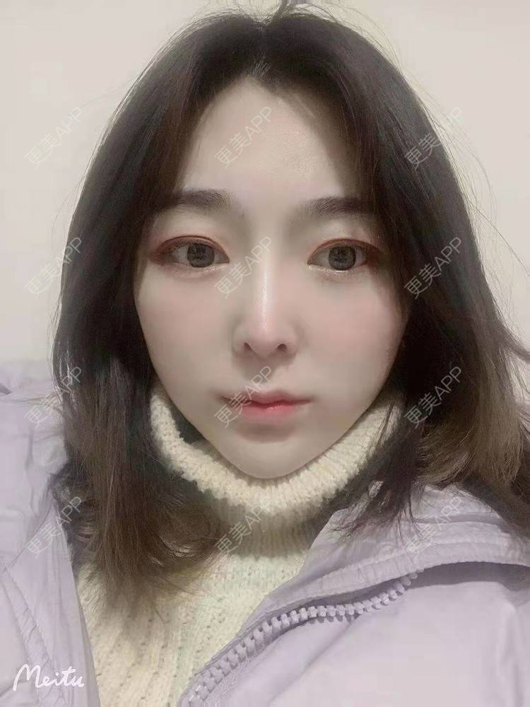 更美 - 更美用户aoql3tHMzk的隆鼻经验 | 自体脂肪全面部填充 | 自体脂肪填充泪沟 | 自体脂肪垫下巴 | 自体脂肪丰额头 | 自体脂肪填充法令纹 | 隆鼻 | 鼻部多项 | 肋软骨隆鼻 | 鼻翼缩小 | 鼻中隔软骨隆鼻 | 鼻小柱延长 | 耳软骨隆鼻